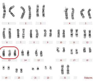 13-三体综合征