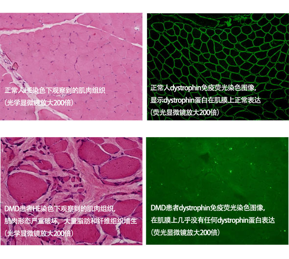 进行性肌营养不良肌肉活检HE染色体和dystrophin蛋白免疫荧光染色结果