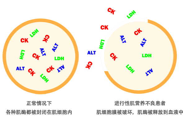 进行性肌营养不良（DMD/BMD）患者血液中肌酶（肌酸激酶CK）升高原因示意图