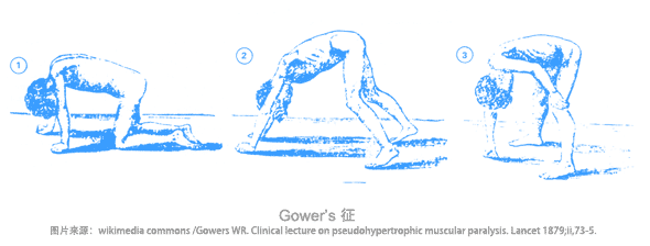 进行性肌营养不良患者的Gower's征