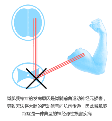 脊肌萎缩症的发病原因