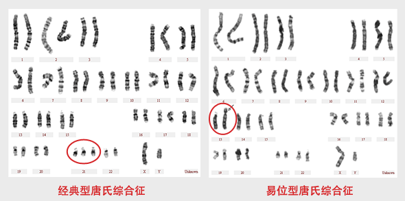 唐氏综合征核型